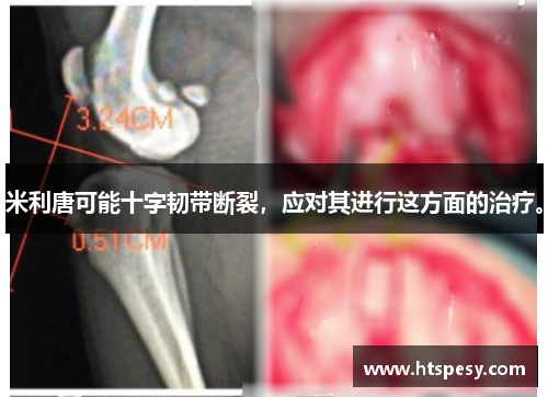 米利唐可能十字韧带断裂,应对其进行这方面的治疗。 米利唐可能十字韧带断裂,应对其进行这方面的治疗。